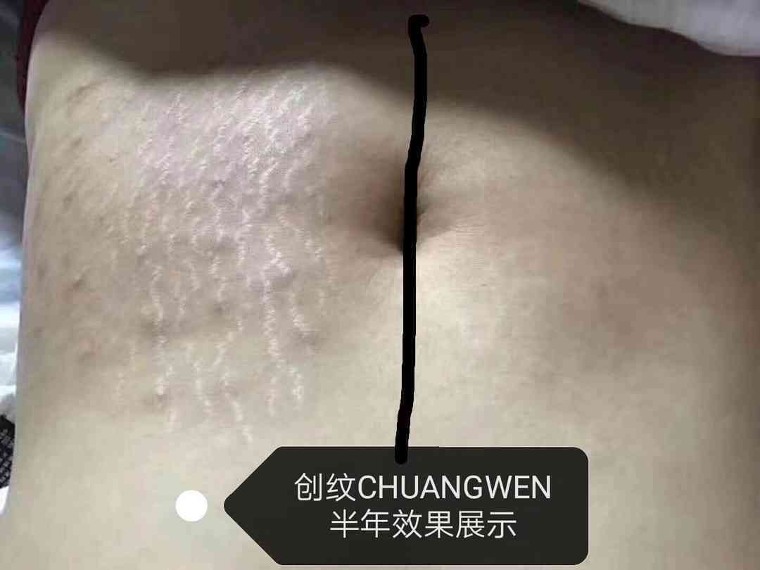 妊娠纹怎么去掉？有哪些防妊娠纹的用品推荐？ - 知乎